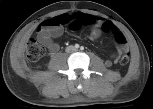 Recreation of the abdominal wall contour is seen on the post-operative computed tomography.