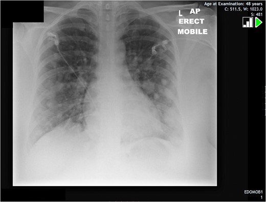 Chest X-ray displaying multiple widespread pulmonary nodules.