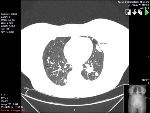 Section from CT scan showing largest individual lung lesion in the lingula measuring 3.5 cm.