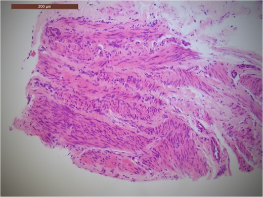 Haemotoxylin & eosin (H&E) stain showing pink spindle cells.