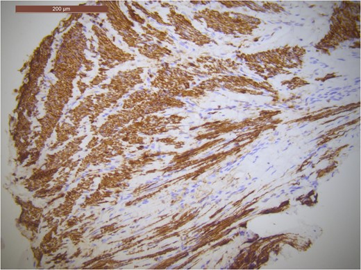 Immuno-stain with brown staining indicating expression of desmin protein as seen in smooth muscle cells.