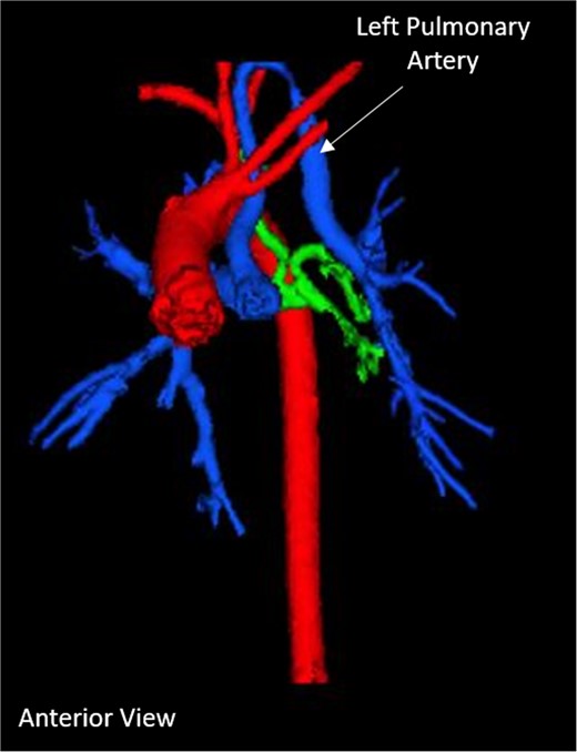 Pre-operative 3D-CT reconstruction showing the left pulmonary artery ascending into the neck.