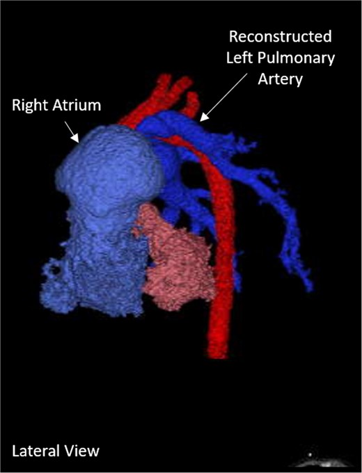 Post-operative 3D-CT reconstruction showing the repaired left pulmonary artery.