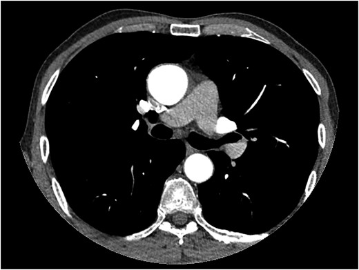 Thorax CT angiography showing the dilatation of ascending aorta of a patient before surgery on admission to our center.
