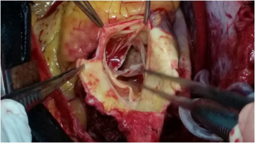 A picture that shows a chronic dissection flap of a patient during surgery.