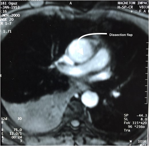 Thorax MR of a patient 15 years ago shows a dissection flap.