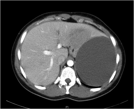 Computed tomography showing a giant splenic cyst.