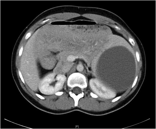 Computed tomography showing medial displacement of the stomach and the left kidney by the cyst.