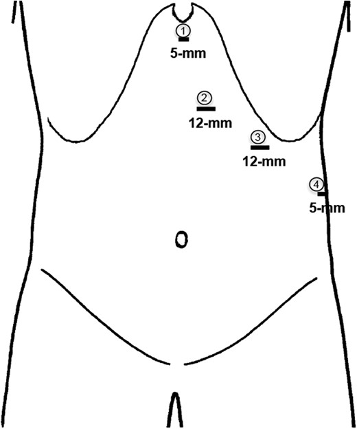 A schematic illustration of the ports positions. The working ports are numbered 1 and 3, port 2 is for the laparoscope, while port 4 is for a 5-mm diamondflex retractor.