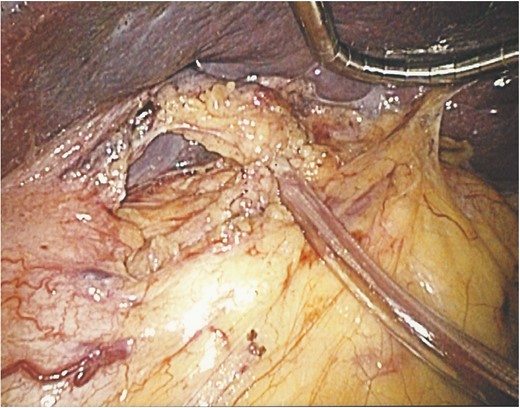 An operative image showing the splenic hilum slung with the vascular tape and clamped with a segment of a nasogastric tube.
