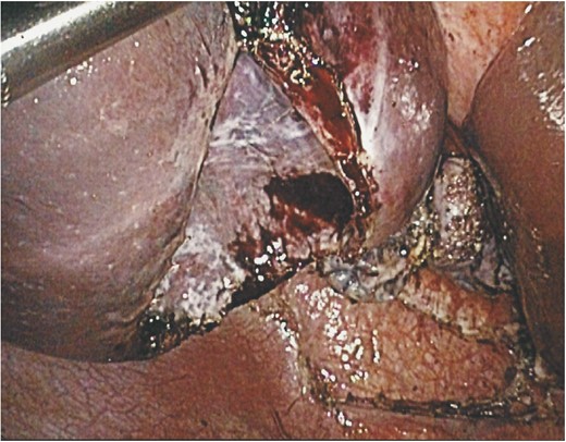 An operative image showing the splenic cyst after de-capsulation with a bloodless bed and minimal bleeding from edges of the cyst.