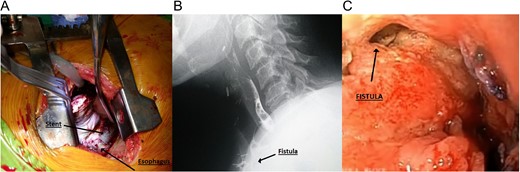 (A) Metal stent seen during thoracotomy. (B) Cervical fistula seen during esophagogram. (C) Cervical fistula seen during upper endoscopy.