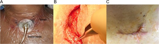 (A) Functional V.A.C. system in-patient. (B) Granulation tissue in the cervical wound. (C) Wound after therapy.