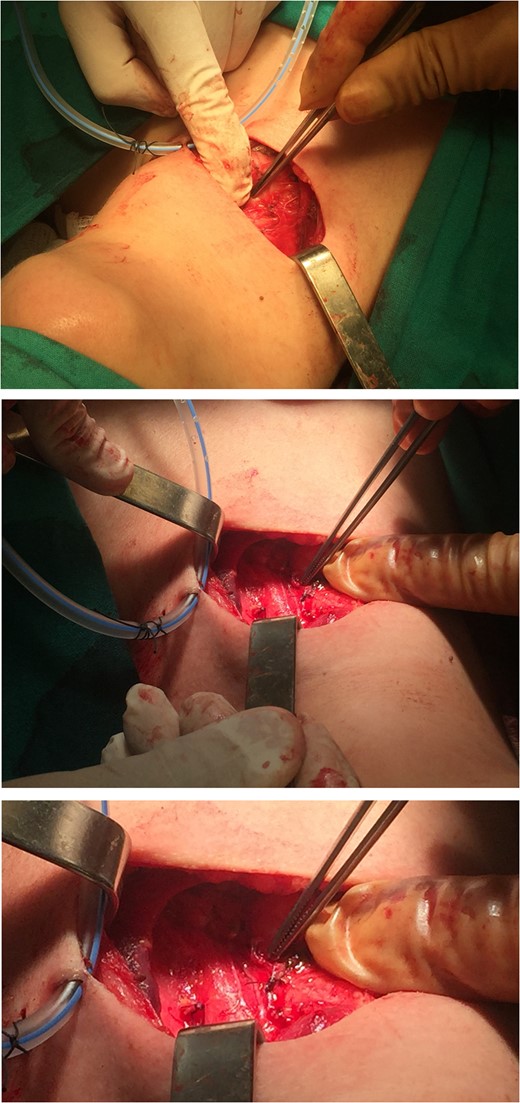Extralaryngeal division of the left RLN was incidentally located at a mean distance of 7 cm from the left CTJ.