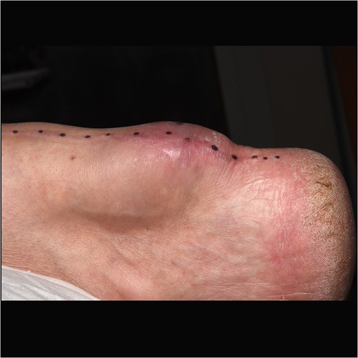 Swelling over right Achilles tendon.