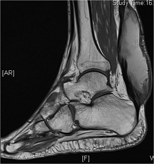 MRI scan. T2 PD fat sat sequence sagittal image of right ankle showing high-signal collection within the Achilles tendon.
