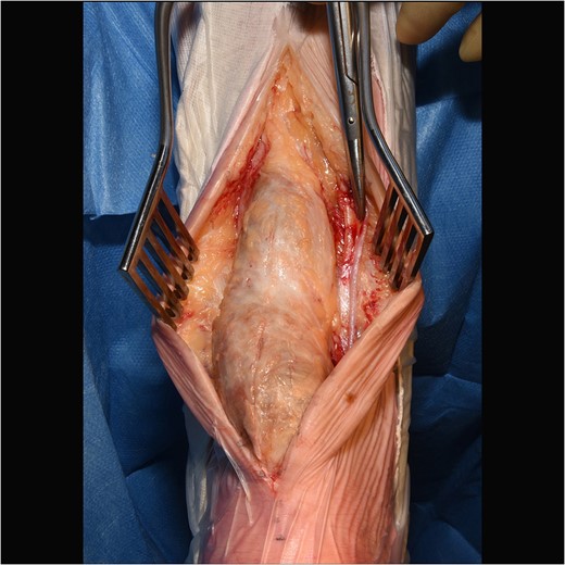 Intraoperative image of large cystic swelling over Achilles tendon.