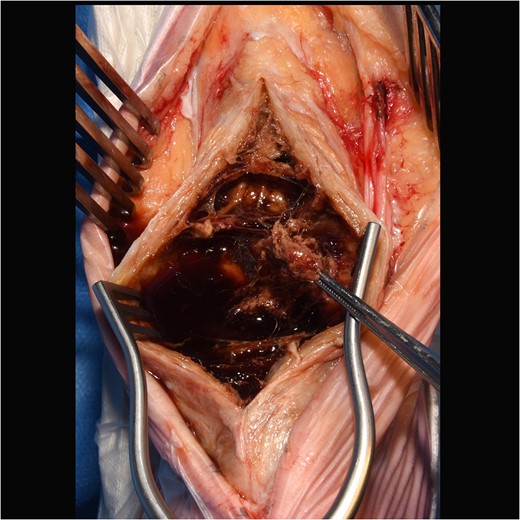 Intraoperative image showing internal cystic granuloma within Achilles.
