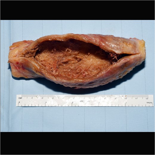 Excised LARS ligament specimen.