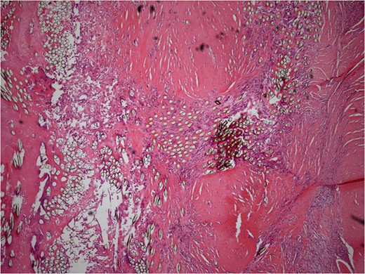 Low power histology slide showing foreign body giant cell reaction to suture material.
