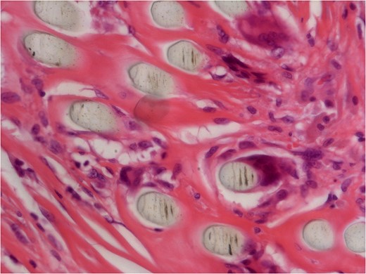 40× histology slide showing foreign body giant cell reaction to suture material.