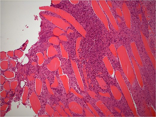 40× histology slide showing abscess extension into muscle.