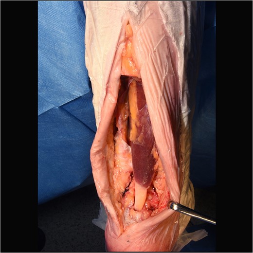 Intraoperative image of FHL transferin situ.