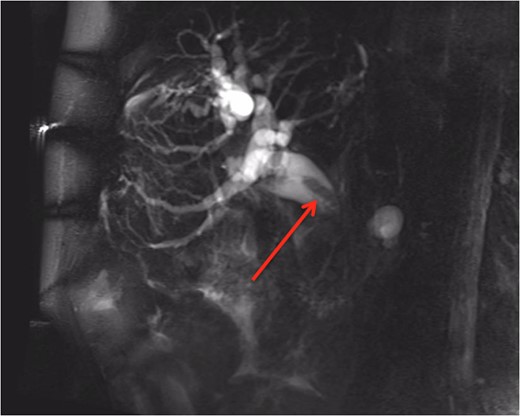 MRCP showing an obstruction of the biliary tract (identified with red arrow) transitioning at the ampulla.