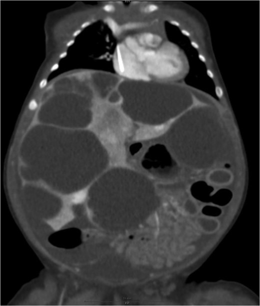 Large cystic lesions with internal septation associated with heterogeneous small solid lesions with arterial enhancement.