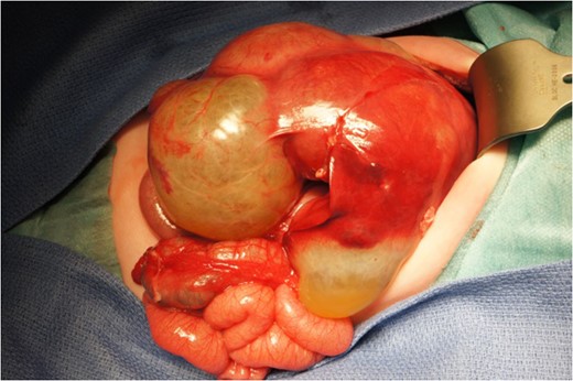 Intraoperative view of the hepatic cysts before excision.