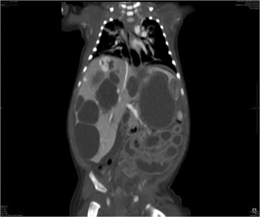 Liver parenchyma invaded by multiple enlarging cysts varied in sizes and shapes.