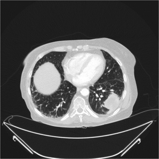 Axial view of chest CT showing left lower lobe lesion.
