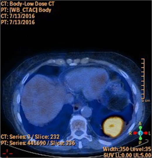PET-CT showing FDG uptake in left lower lobe.