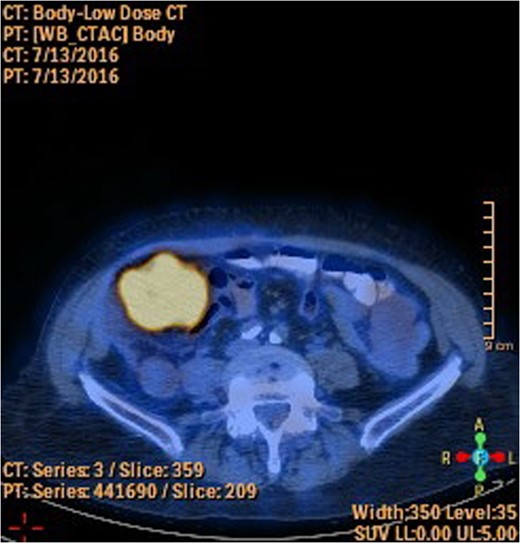 PET-CT showing FDG uptake in cecum.