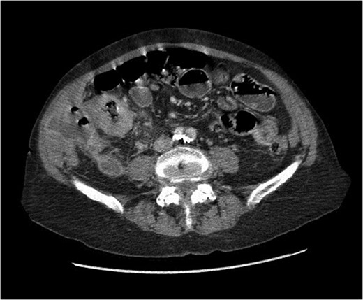 Abdominal CT scan showing annular cecal mass with evidence of perforation.