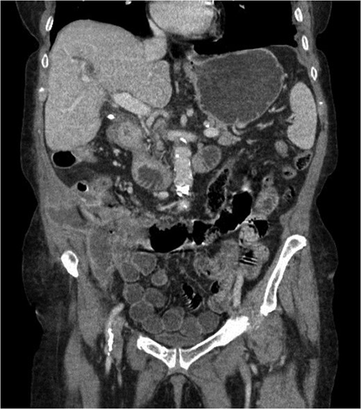 Coronal view of abdominal CT scan showing cecal mass with evidence of perforation.
