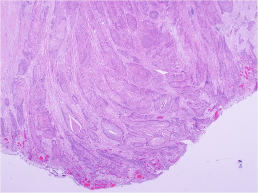 Carcinoma involving colonic serosa (image courtesy Dr Maisoun Abdelbaqi, Department of Pathology, Red Deer Regional Hospital, Alberta, Canada).
