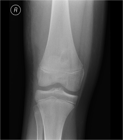 Radiograph on presentation to A + E. The radiograph displays ‘a well corticated lesion (15 mm × 17 mm) in the distal femur’.
