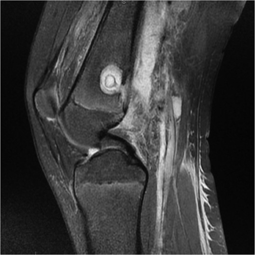 MRI Images on admission to Hospital. MRI images displaying ‘osteomyelitis with sequestration and erosion through the posterior cortex, extensively extending into the surrounding soft tissues’.