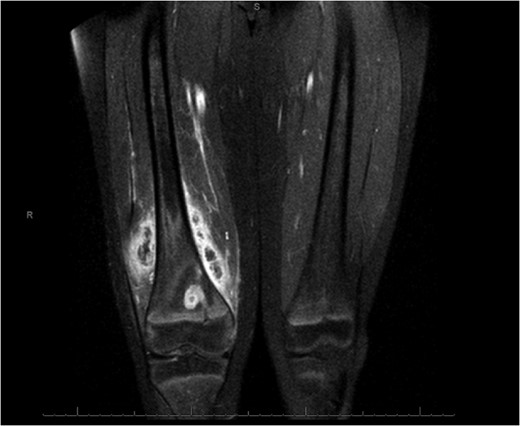 Coronal slice images of presenting MRI, displaying the brodie's abscess and collection.