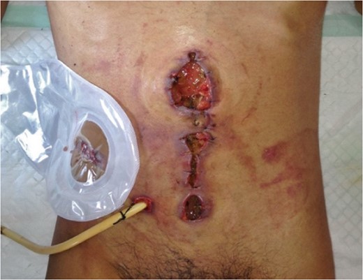 Wound dehiscence and deep surgical site infection after laparotomy, with multiple fistulas at the surgical site and at the old drainage wound (colostomy bag). The catheter placed is a tube ileostomy.