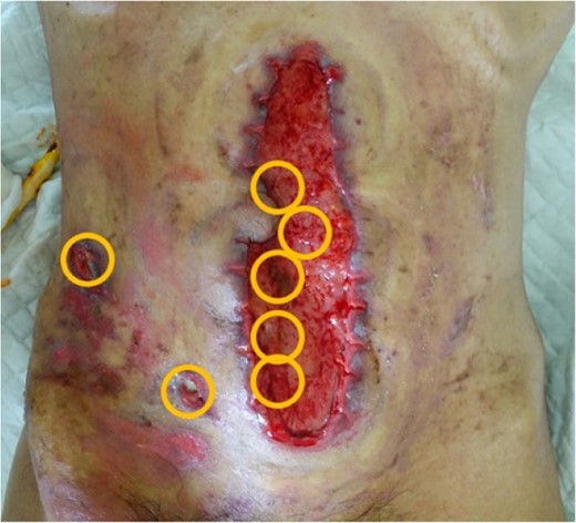 One month after conservative treatment without NPWT. The active high output fistulas are pointed with yellow circles.