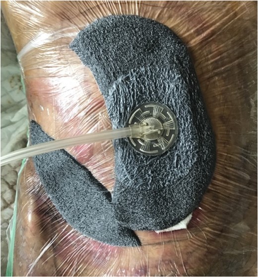 After first application of NPWT. White foam was applied on wound surfaces with fistulas, and covered using a black granufoam. The remaining wound surfaces without fistulas were covered using black granufoam alone.
