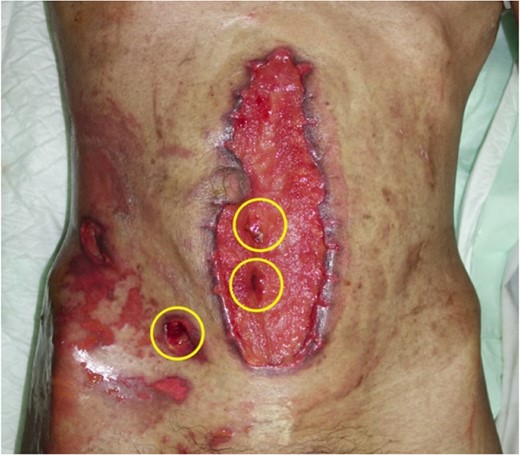 Wound condition after 1 week treated using NPWT, with three low fistulas remaining, as indicated using yellow circles.