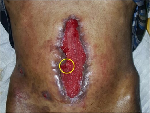 Wound condition after 1 month treated using NPWT, with one low fistula remaining. Healthy granulation tissue indicates the wound is ready for closure.