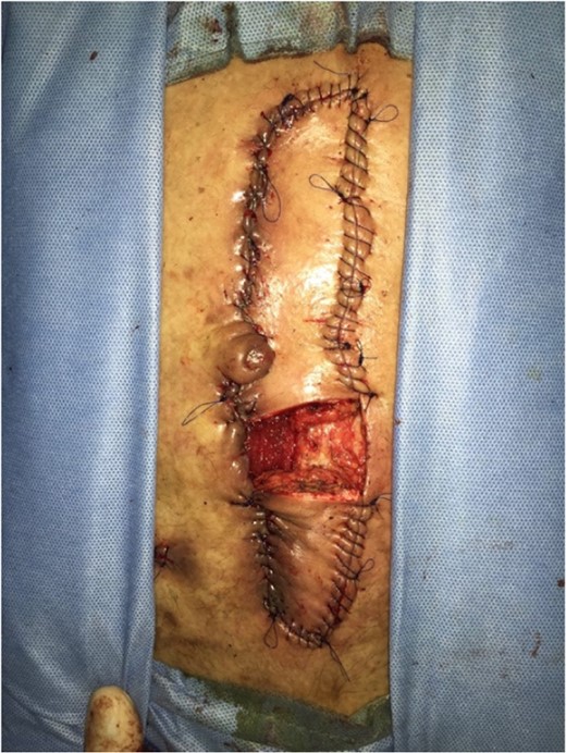 Wound condition after closure using Keystone flap, with window around one active low output fistula.