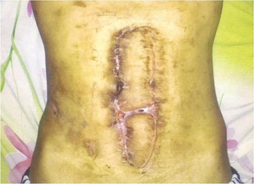 One month after closure using flap. Wound contracted, with no active fistula.