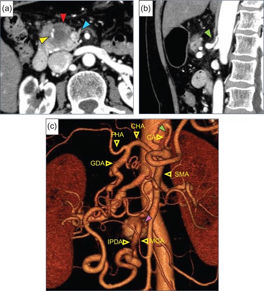 (a) Enhanced abdominal CT showed a low-density tumor (red arrow), 30 mm in diameter, in the pancreatic head. The superior mesenteric vein (SMV, blue arrow) and gastroduodenal artery (GDA, yellow arrow) were involved by this tumor. (b) Stenosis of the celiac artery (CA) was shown (green arrow). (c) Preoperative 3D CT angiogram showed the development of pancreatic artery arcade and a saccular aneurysm (purple arrow) of the inferior pancreaticoduodenal artery (IPDA), 20 mm in diameter. CHA, common hepatic artery; PHA, proper hepatic artery; SMA, superior mesenteric artery; MCA, middle colic artery.