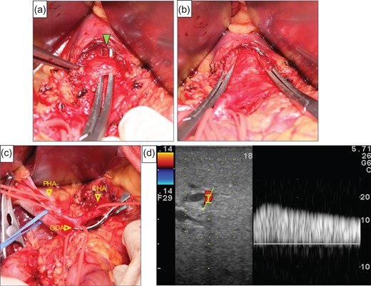 (a) The median arcuate ligament (green arrow) compressed the CA. (b) Compression of the origin of the CA by the ligament was released. (c) The image shows that the GDA was clamped. (d) We checked the hepatic artery flow under GDA clamping, but the flow had not improved satisfactory.
