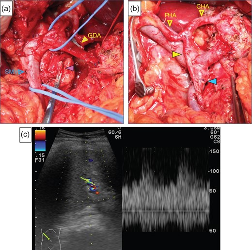 (a) The purple arrow indicates the stump of the aneurysm. (b) The image was after reconstruction by end-to-end anastomosis of the GDA and the MCA (yellow arrow). The blue arrow indicates the anastomotic part of the SMV. (c) We checked the hepatic arterial flow after reconstruction, the hepatic arterial signal had increased.